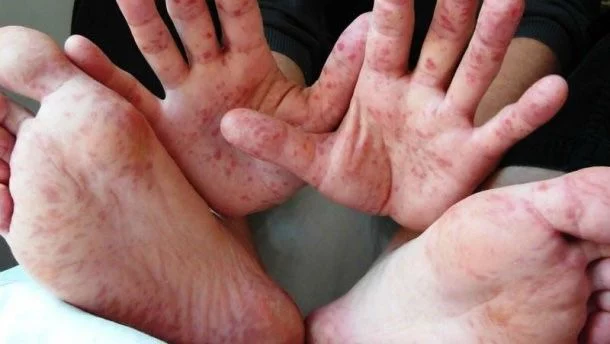 Қазақстанда 2 бала қызылша ауруынан көз жұмды - изображение 1