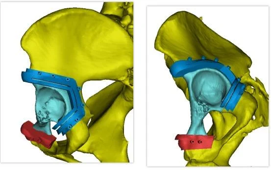 Изображение 2 для Казахстанские врачи заменили таз отечественным 3D-имплантом пациентке с раком